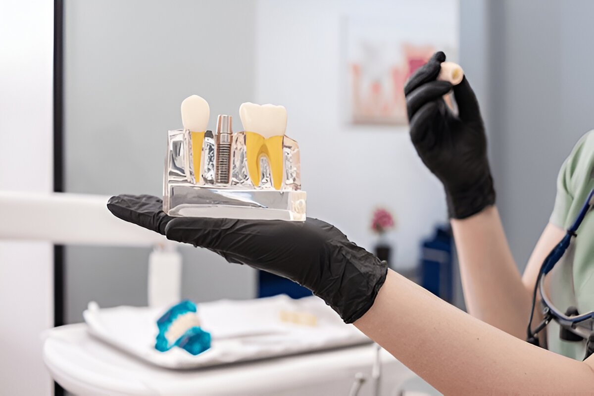 Dental Crown in Hamilton