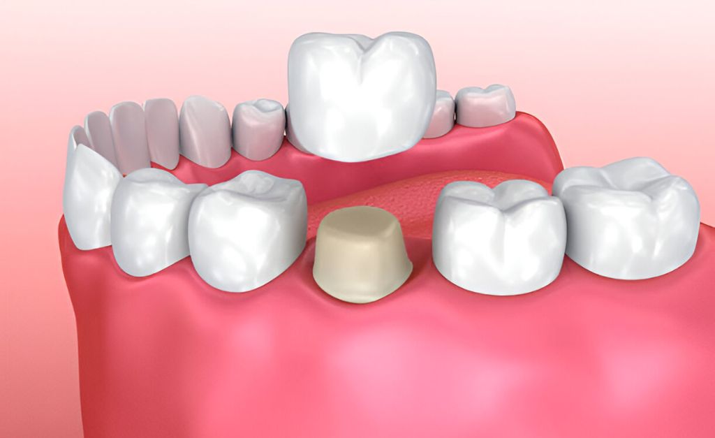 dental crowns near you