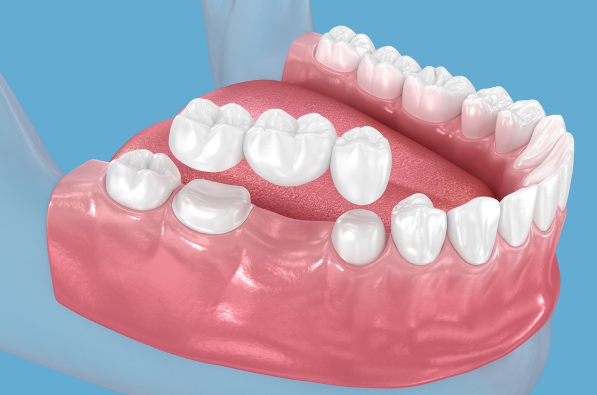 dental bridge care for healthy gums